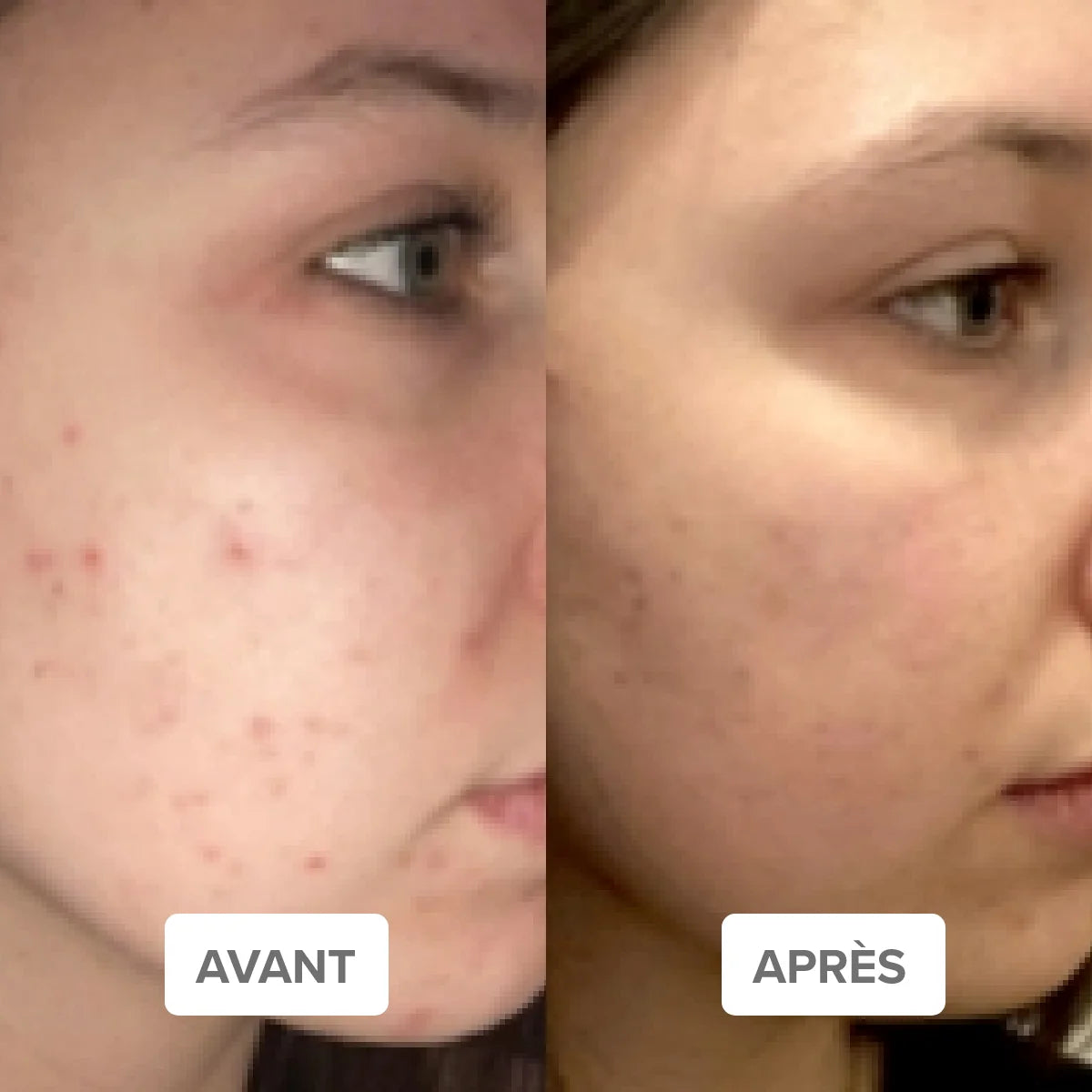 Routine Peau Zéro Défaut - Peau acnéique